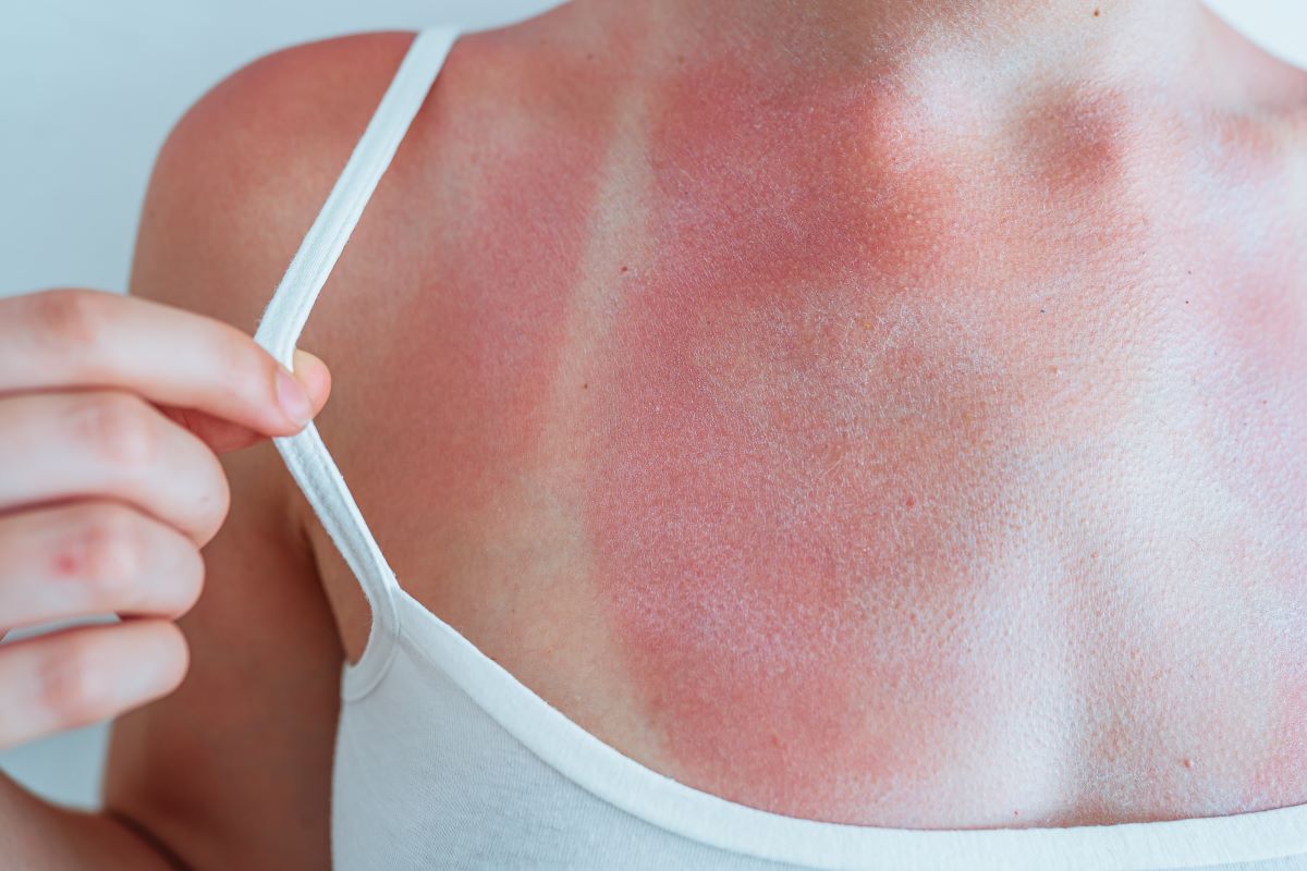 Sonnenbrand in Aachen vermeiden und richtig behandeln – Ein 